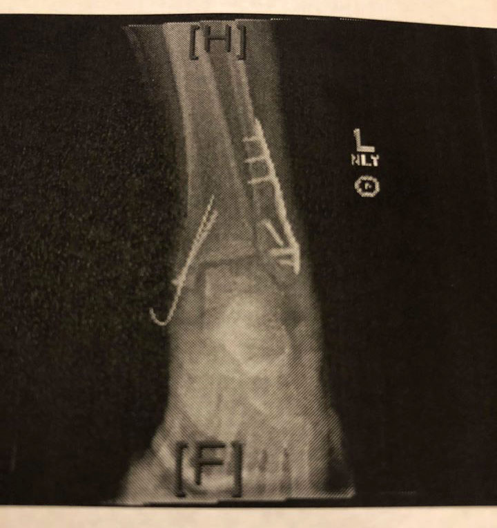Sondi's Broken Ankle